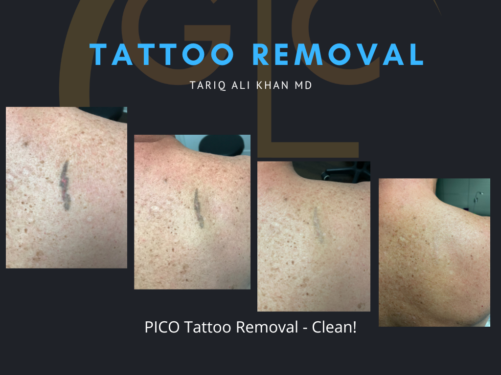 Gentle Care Laser Tustin Before and After picture - Tattoo Removal Mucosal Surface